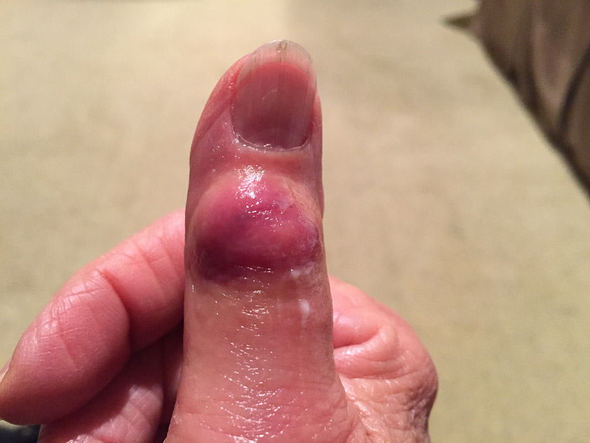 Mariana's right thumb about 12 hours after it was bitten at night in bed in our hotel in Hakone.